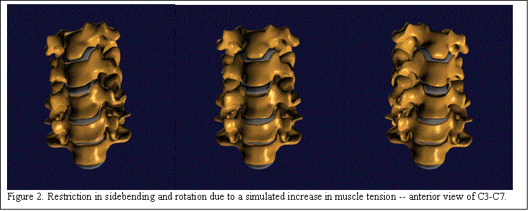 Text Box:    
Figure 2. Restriction in sidebending and rotation due to a simulated increase in muscle tension -- anterior view of C3-C7.
